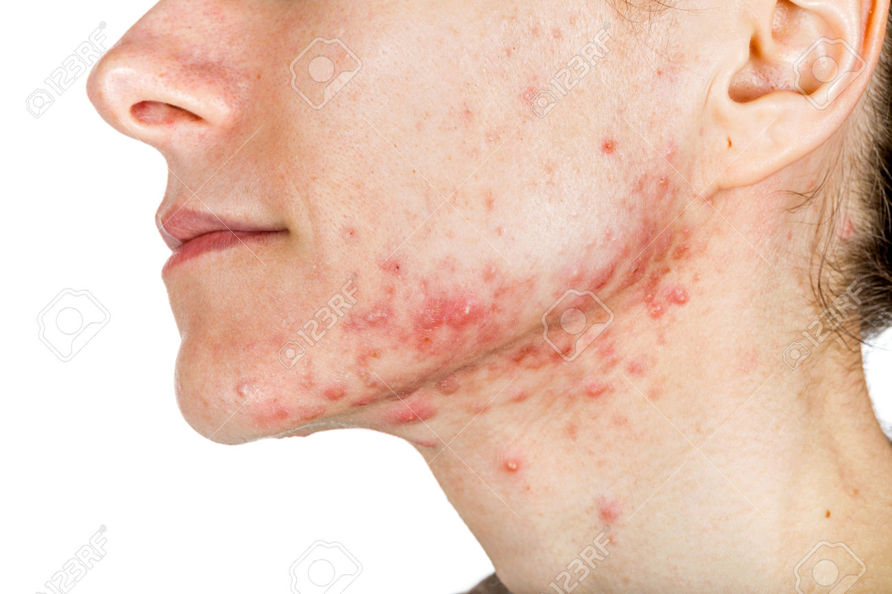 Image result for त्वचा की एलर्जी