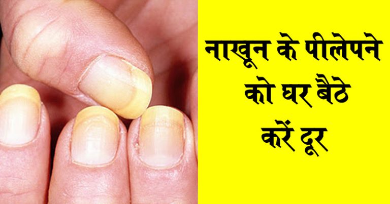 पीले नाख़ून होने पर शर्मिंदा ना हो ऐसे करे इलाज पीले नाख़ून होने पर शर्मिंदा ना हो ऐसे करे इलाज